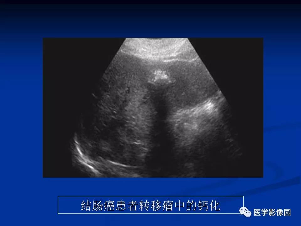 【PPT】肝脏转移瘤的影像学诊断