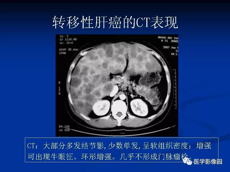 【PPT】肝脏转移瘤的影像学诊断
