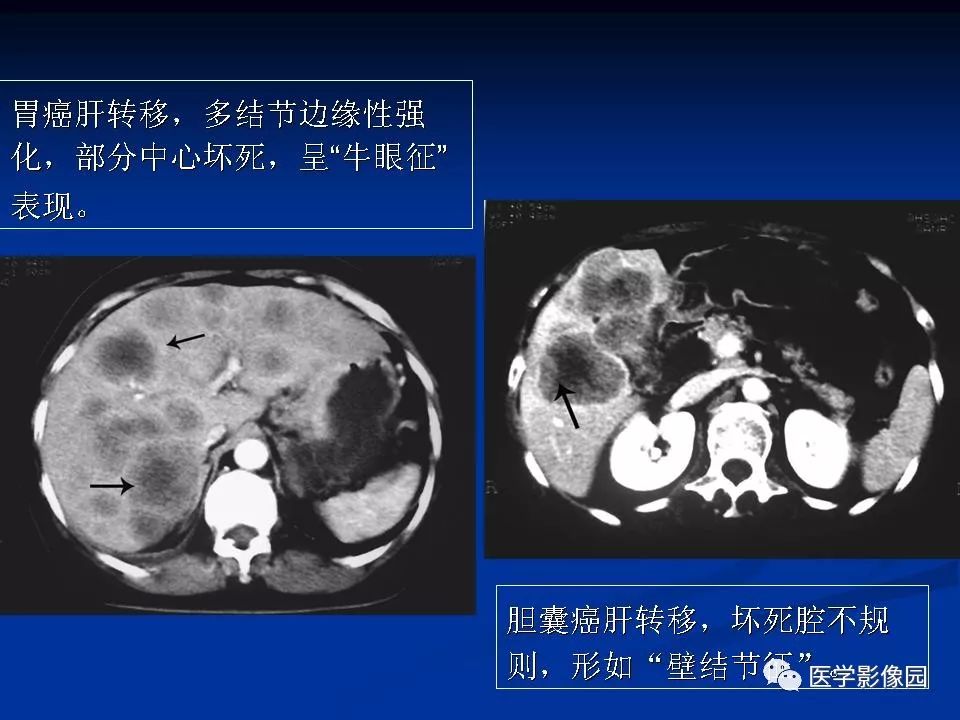【PPT】肝脏转移瘤的影像学诊断