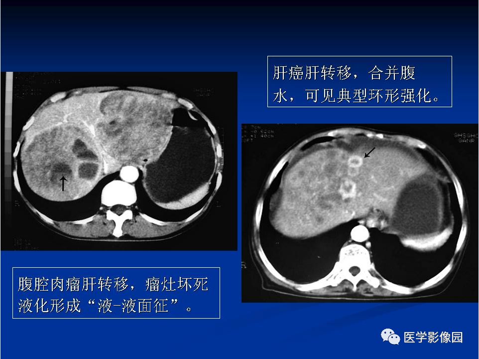【PPT】肝脏转移瘤的影像学诊断