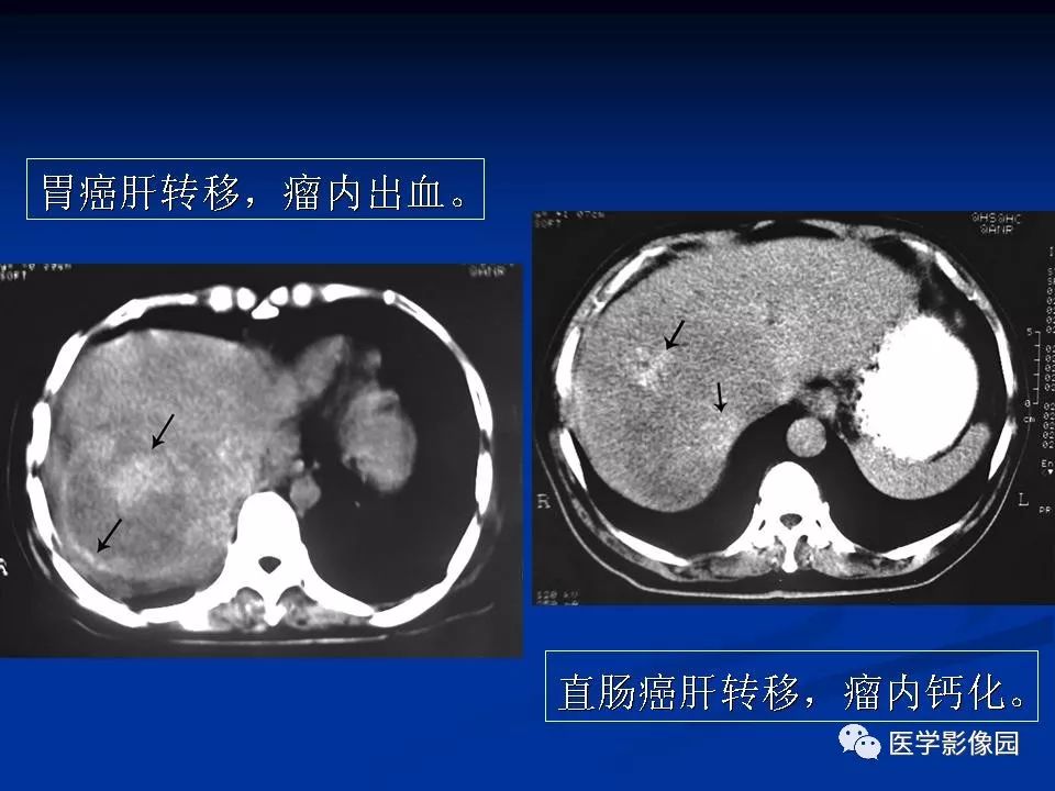 【PPT】肝脏转移瘤的影像学诊断