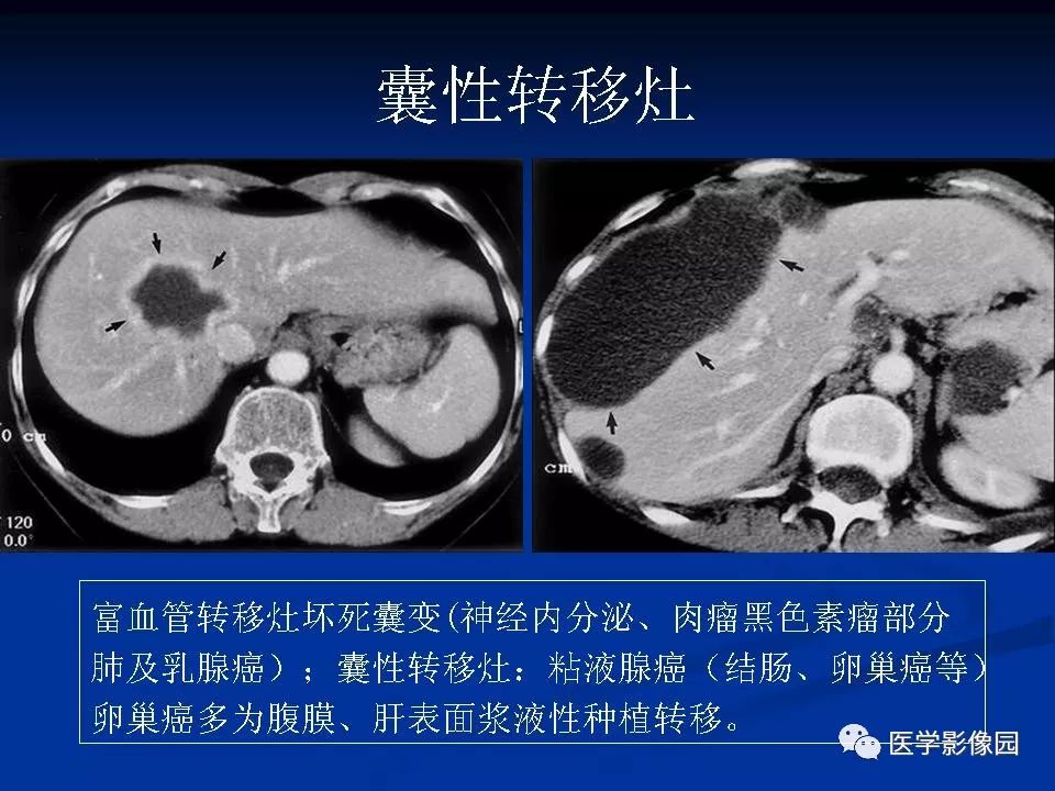 【PPT】肝脏转移瘤的影像学诊断