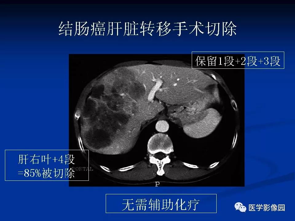【PPT】肝脏转移瘤的影像学诊断