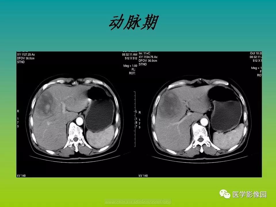 【病例】肝脏转移性黑色素瘤1例CT影像表现