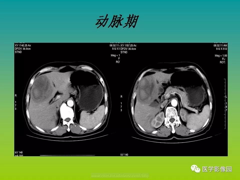 【病例】肝脏转移性黑色素瘤1例CT影像表现