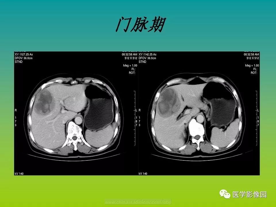 【病例】肝脏转移性黑色素瘤1例CT影像表现