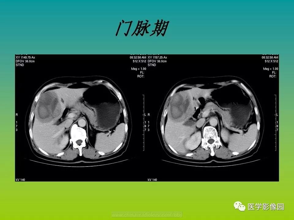 【病例】肝脏转移性黑色素瘤1例CT影像表现