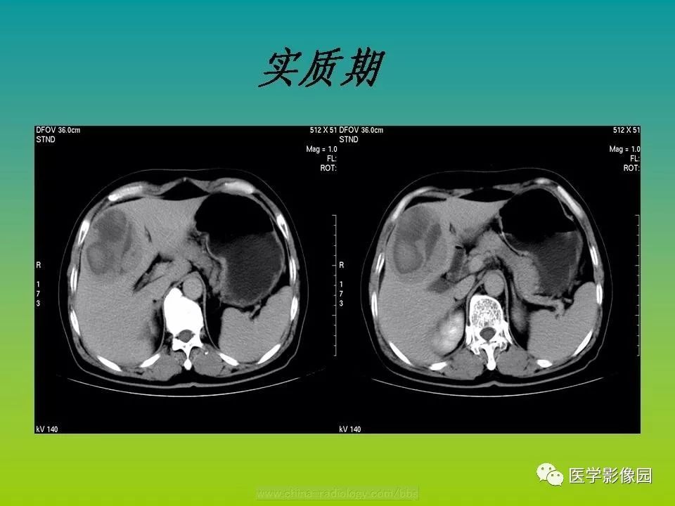 【病例】肝脏转移性黑色素瘤1例CT影像表现
