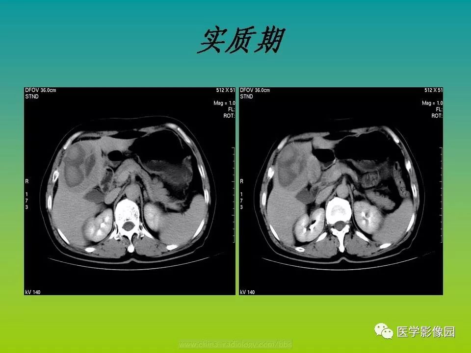 【病例】肝脏转移性黑色素瘤1例CT影像表现