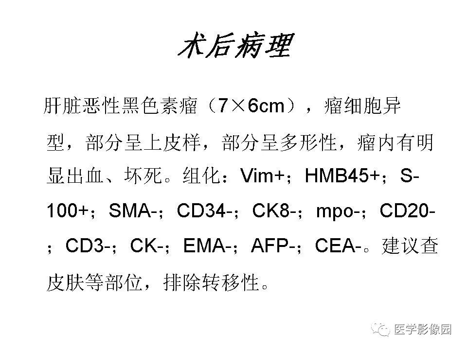 【病例】肝脏转移性黑色素瘤1例CT影像表现