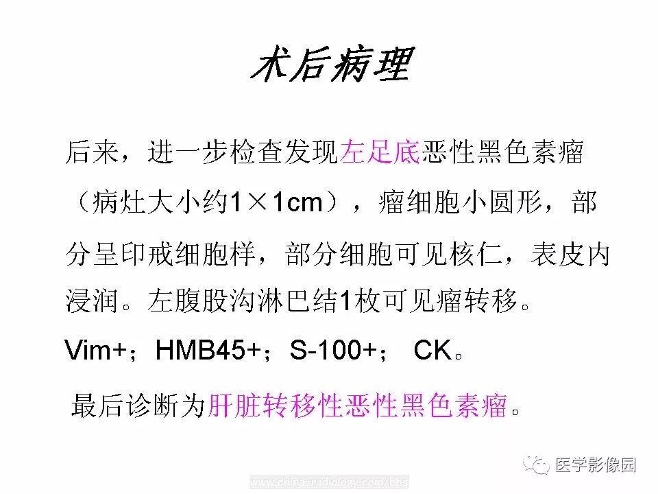 【病例】肝脏转移性黑色素瘤1例CT影像表现