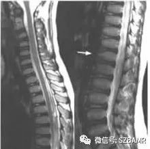 休门氏病(青少年驼背最常见病因)的影像表现与临床 休门氏病(青少年驼背最常见病因)的影像表现与临床