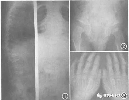 休门氏病(青少年驼背最常见病因)的影像表现与临床 休门氏病(青少年驼背最常见病因)的影像表现与临床