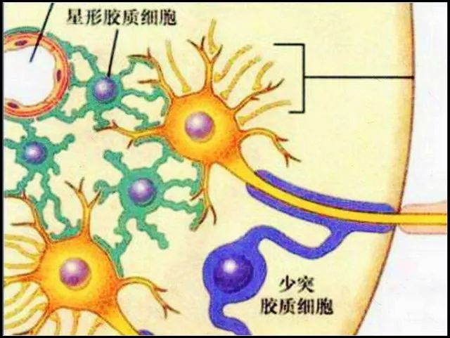 你见到过囊性少突胶质细胞瘤吗? 你见到过囊性少突胶质细胞瘤吗?