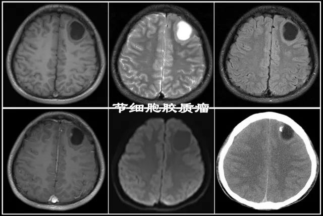 你见到过囊性少突胶质细胞瘤吗? 你见到过囊性少突胶质细胞瘤吗?