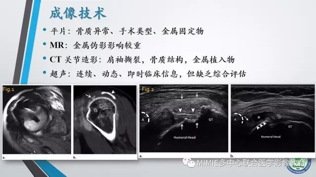 【PPT】术后肩关节影像：肩袖、盂唇及二头肌腱
