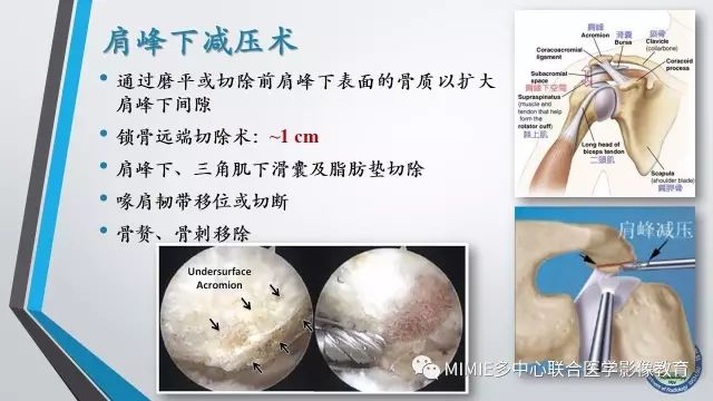 【PPT】术后肩关节影像：肩袖、盂唇及二头肌腱