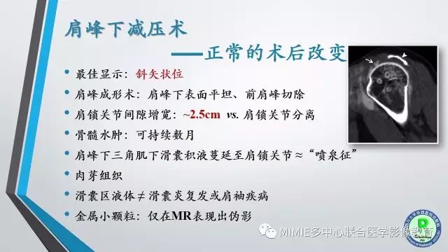 【PPT】术后肩关节影像：肩袖、盂唇及二头肌腱