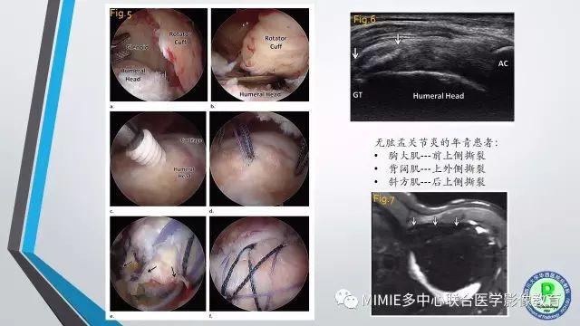 【PPT】术后肩关节影像：肩袖、盂唇及二头肌腱