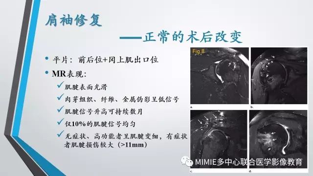 【PPT】术后肩关节影像：肩袖、盂唇及二头肌腱