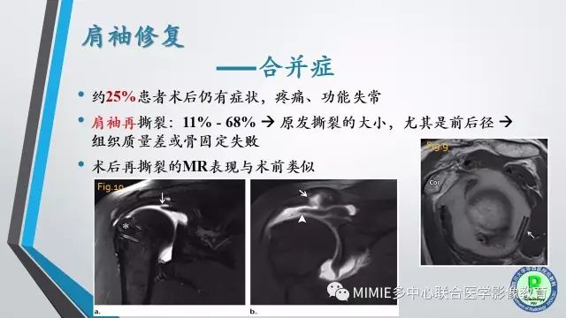 【PPT】术后肩关节影像：肩袖、盂唇及二头肌腱