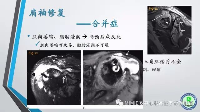 【PPT】术后肩关节影像：肩袖、盂唇及二头肌腱