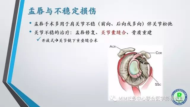 【PPT】术后肩关节影像：肩袖、盂唇及二头肌腱