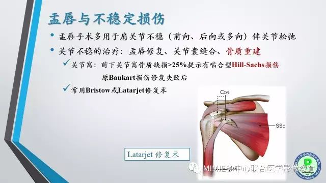 【PPT】术后肩关节影像：肩袖、盂唇及二头肌腱