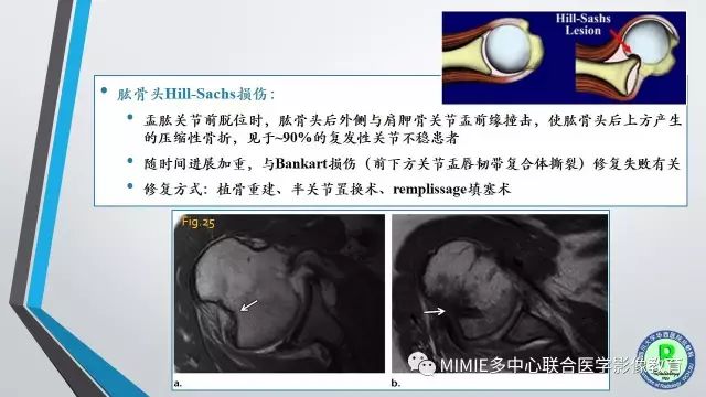 【PPT】术后肩关节影像：肩袖、盂唇及二头肌腱