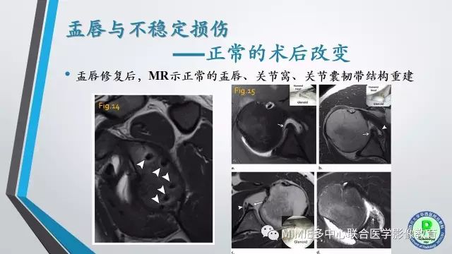 【PPT】术后肩关节影像：肩袖、盂唇及二头肌腱