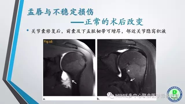 【PPT】术后肩关节影像：肩袖、盂唇及二头肌腱