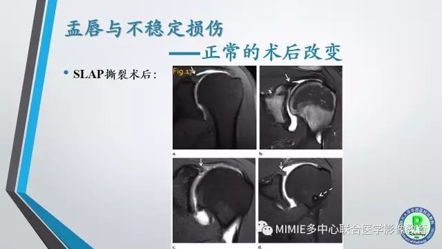 【PPT】术后肩关节影像：肩袖、盂唇及二头肌腱