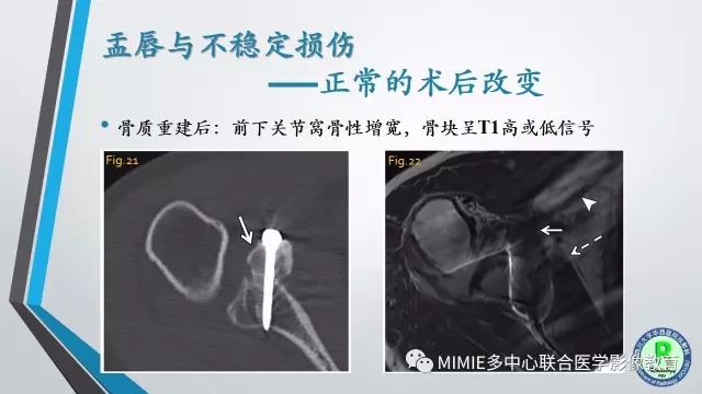 【PPT】术后肩关节影像：肩袖、盂唇及二头肌腱