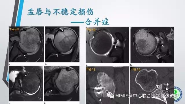 【PPT】术后肩关节影像：肩袖、盂唇及二头肌腱
