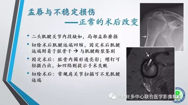 【PPT】术后肩关节影像：肩袖、盂唇及二头肌腱