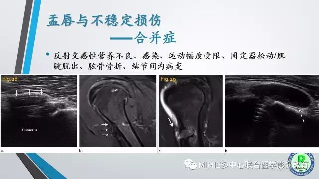 【PPT】术后肩关节影像：肩袖、盂唇及二头肌腱