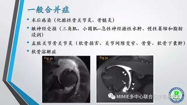 【PPT】术后肩关节影像：肩袖、盂唇及二头肌腱