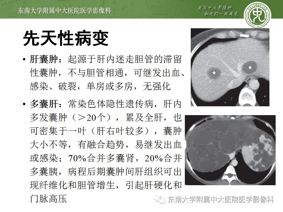 【病例】肝包虫囊肿VS胆管囊腺癌