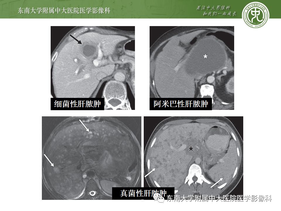 【病例】肝包虫囊肿VS胆管囊腺癌