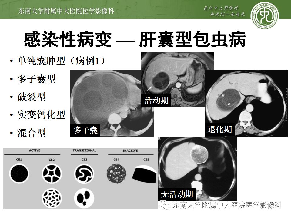 【病例】肝包虫囊肿VS胆管囊腺癌