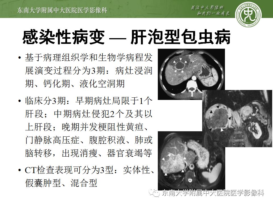 【病例】肝包虫囊肿VS胆管囊腺癌