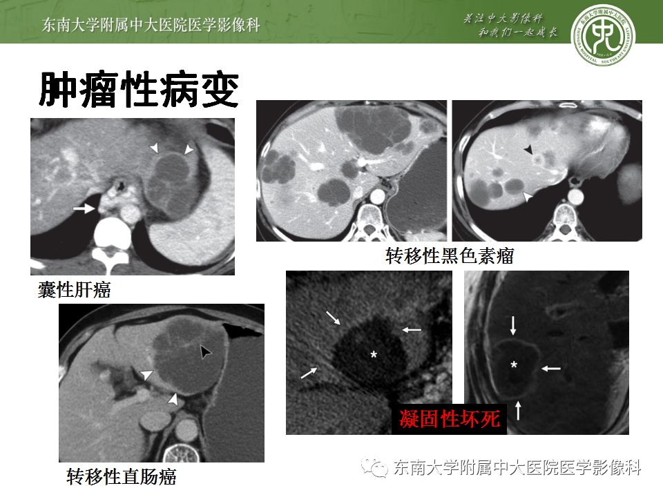 【病例】肝包虫囊肿VS胆管囊腺癌