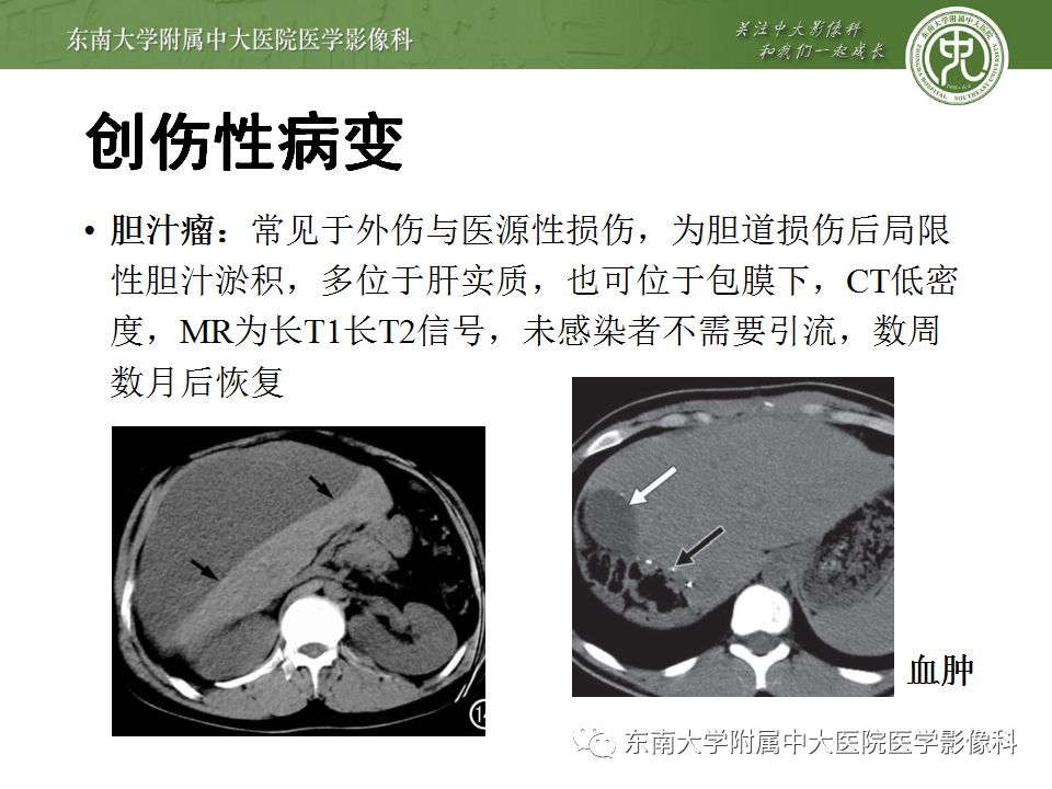 【病例】肝包虫囊肿VS胆管囊腺癌
