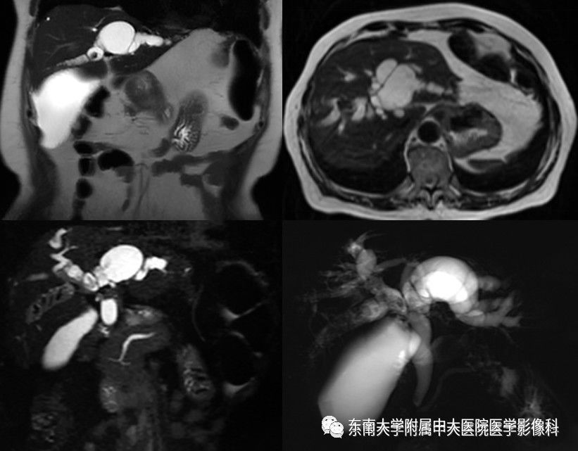【病例】Caroli病1例MR影像表现