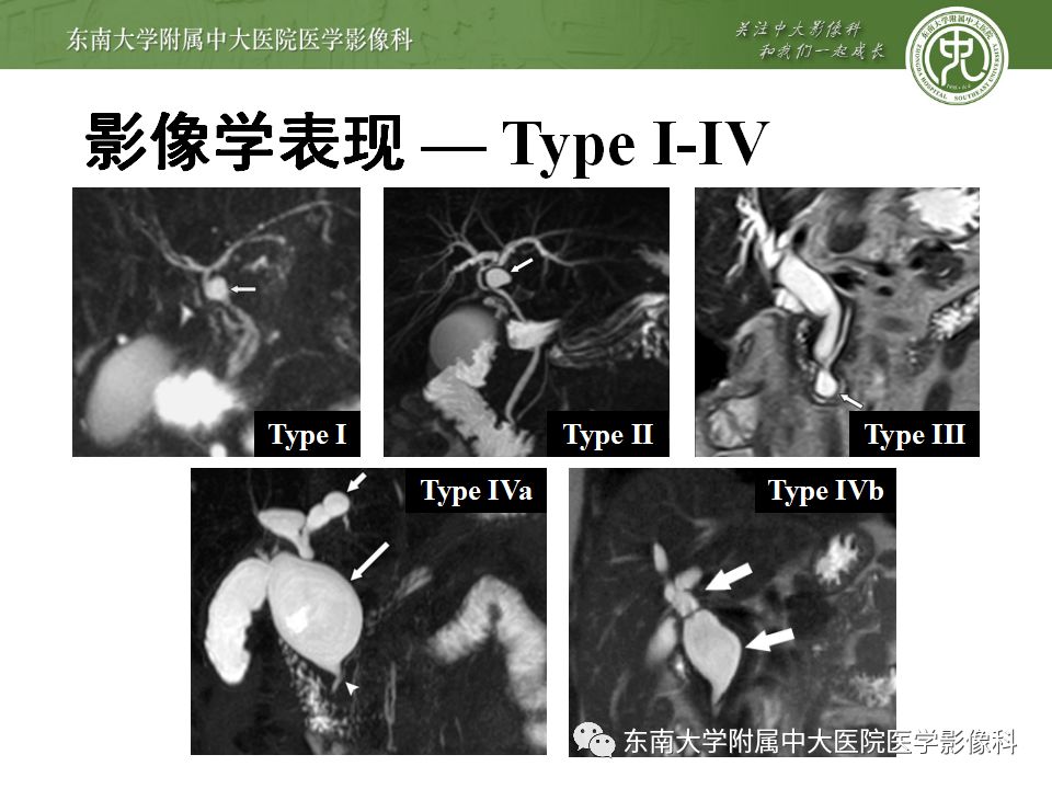 【病例】Caroli病1例MR影像表现