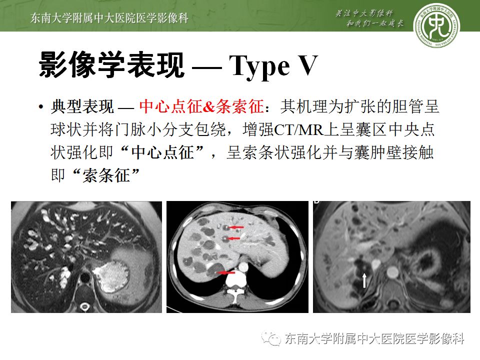 【病例】Caroli病1例MR影像表现