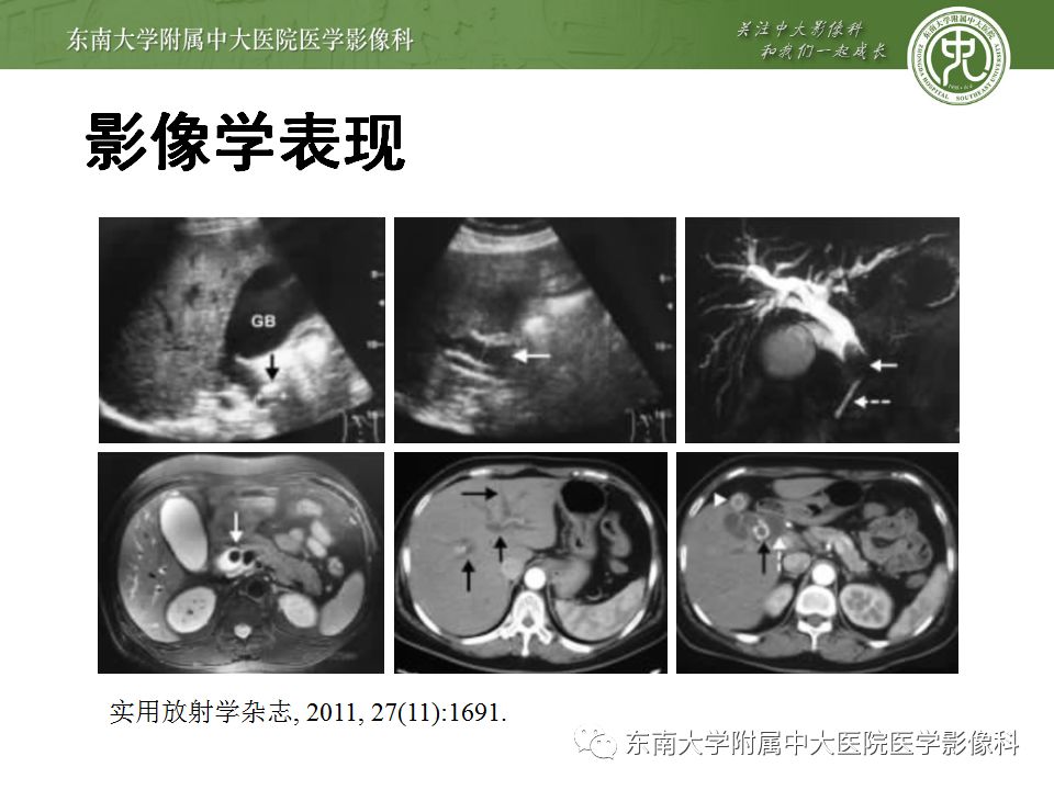 【病例】Caroli病1例MR影像表现