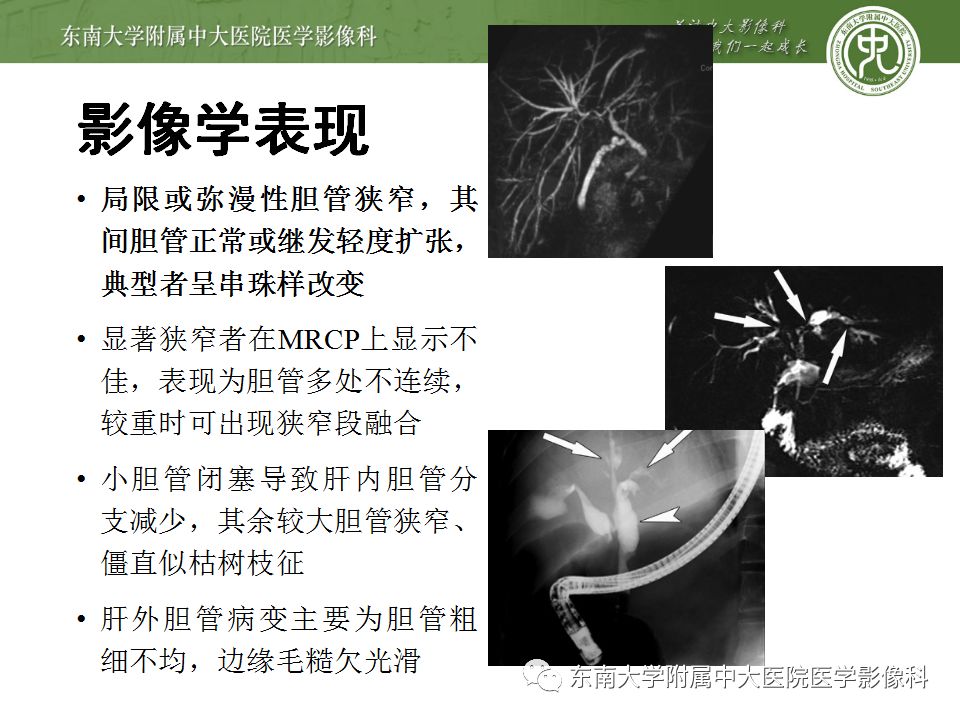 【病例】Caroli病1例MR影像表现