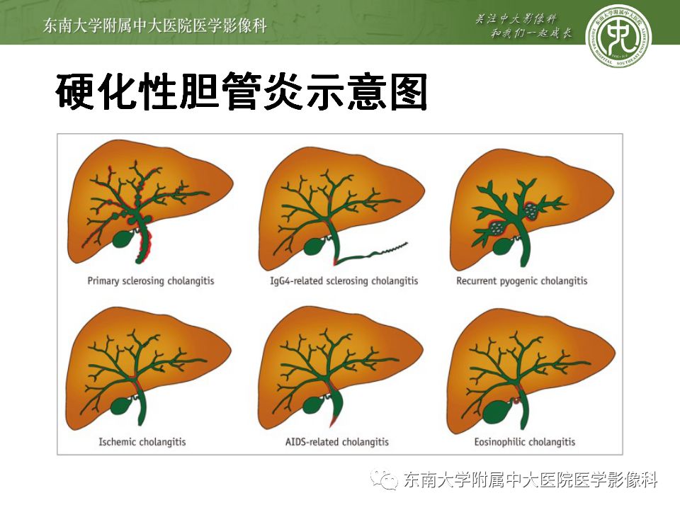 【病例】Caroli病1例MR影像表现