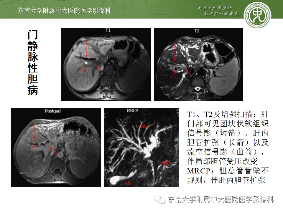 【病例】Caroli病1例MR影像表现